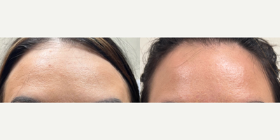 Botox before and after photo