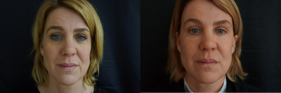 Fraxel Laser before and after photo