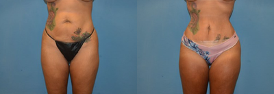 Liposuction before and after photo