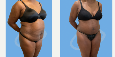 Tummy Tuck before and after photo