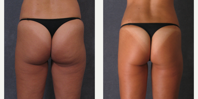 Liposuction before and after photo