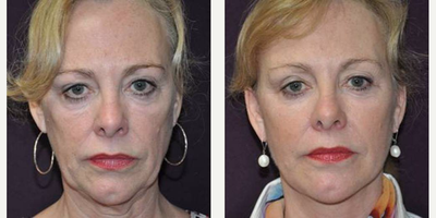 Neck Lift before and after photo