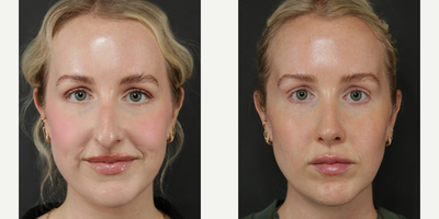 Rhinoplasty before and after photo