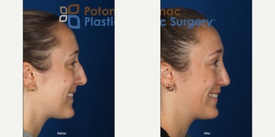 Rhinoplasty before and after photo