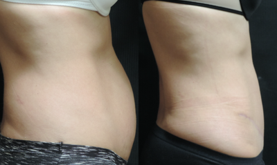 Tummy Tuck before and after photo