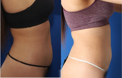 BodyTite before and after photo