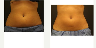 CoolSculpting before and after photo