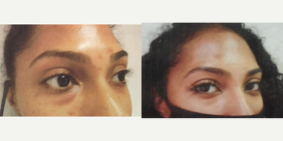 Eyelid Surgery before and after photo