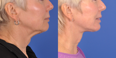 Facelift before and after photo