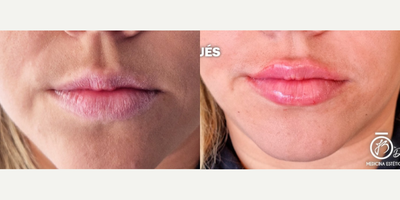 Lip Fillers before and after photo