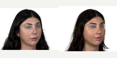 Lip Repositioning before and after photo