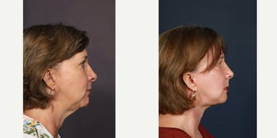 Neck Lift before and after photo