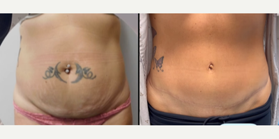 Tummy Tuck before and after photo
