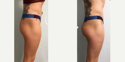 Emsculpt before and after photo