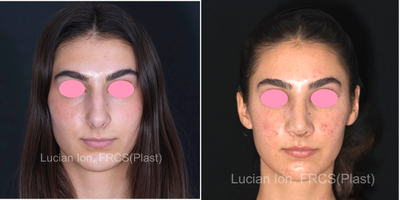 Rhinoplasty before and after photo