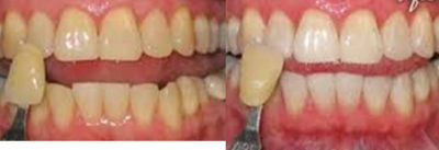 Teeth Whitening before and after photo