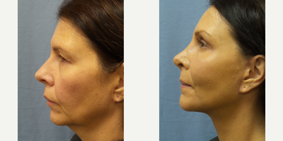 Cheek Lift before and after photo