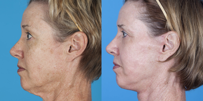 CO2 Laser before and after photo