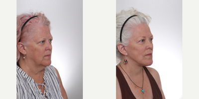Deep Plane Facelift before and after photo