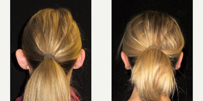 Ear Surgery before and after photo
