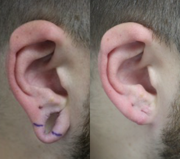 Earlobe Repair before and after photo