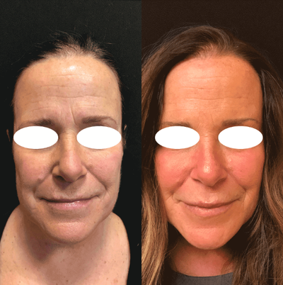 Liquid Facelift before and after photo