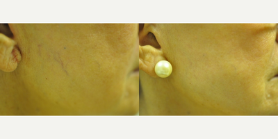 Sclerotherapy before and after photo