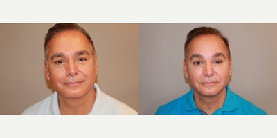 Dysport before and after photo