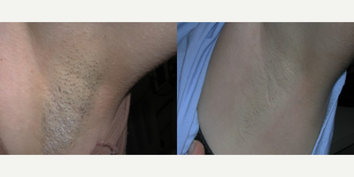 Laser Hair Removal before and after photo