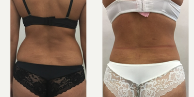 Liposuction before and after photo