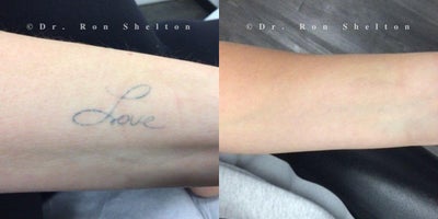 before and after image
