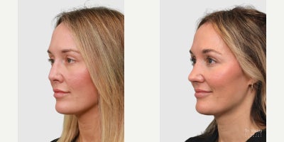 Revision Rhinoplasty before and after photo
