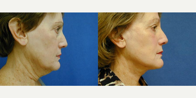 Facelift before and after photo