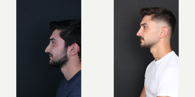 Revision Rhinoplasty before and after photo