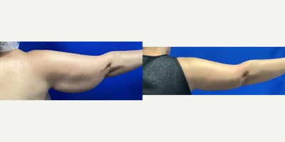 Arm Lift before and after photo