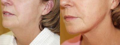 Tumescent Liposuction before and after photo