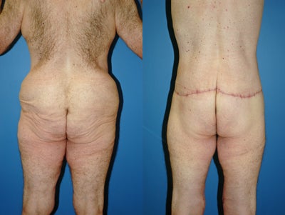 Body Lift before and after photo