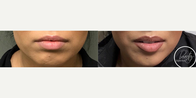 Botox before and after photo