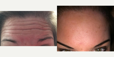Botox before and after photo