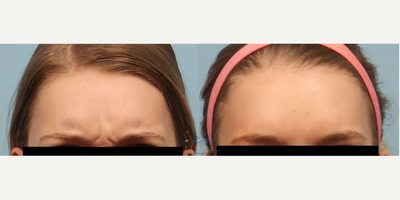 Botox before and after photo