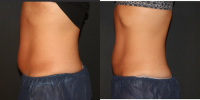 CoolSculpting before and after photo