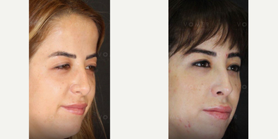 Brow Lift before and after photo
