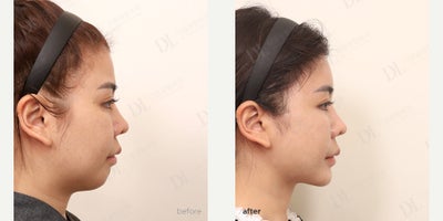 Contour Thread Lift before and after photo