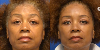 Dermal Fillers before and after photo