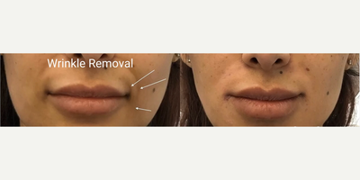 Dermal Fillers before and after photo