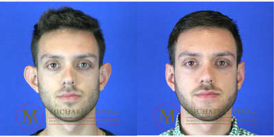 Ear Surgery before and after photo