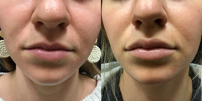 Juvederm before and after photo