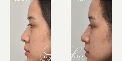 Nonsurgical Nose Job before and after photo