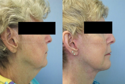 Collagen Injection before and after photo