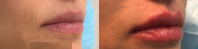 Dermal Fillers before and after photo